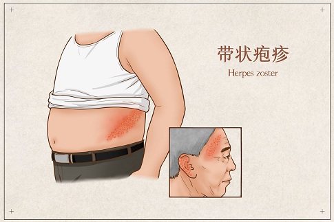 1655737958179292.jpg 攝圖網_401800774_banner_帶狀皰疹醫(yī)療插畫(企業(yè)商用).jpg