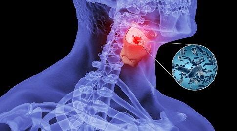 1660752742489556.jpg 攝圖網_401864309_人體咽喉炎場景(企業商用).jpg