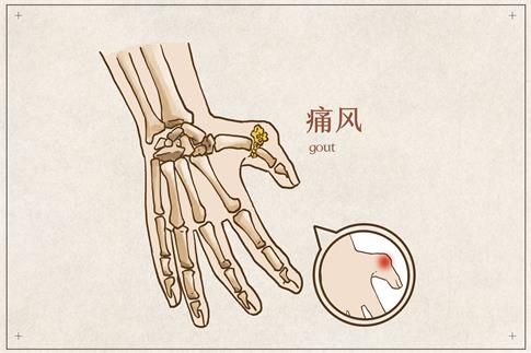 1662050688400722.jpg 攝圖網_401795635_banner_手部痛風病例(非企業商用).jpg