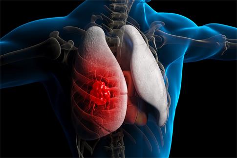 1671841864923621.jpg 攝圖網_401907175_banner_肺病肺癌3D疾病場景(非企業商用).jpg