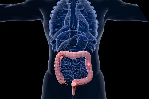 1675353636332072.jpg 攝圖網_401864260_banner_結腸癌場景(非企業商用).jpg