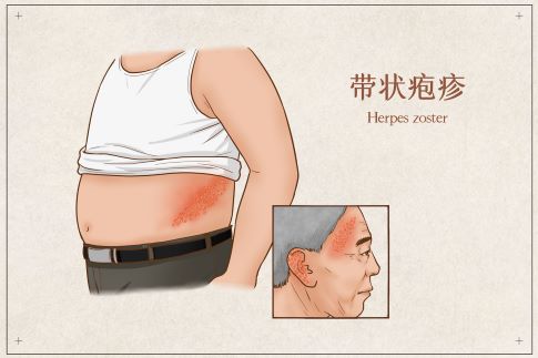 1675558044243317.jpg 攝圖網_401800774_banner_帶狀皰疹醫療插畫(非企業商用).jpg