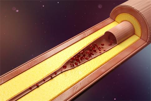 1691981470619197.jpg 攝圖網(wǎng)_402137714_banner_血管狹窄粥樣硬化場景(企業(yè)商用).jpg