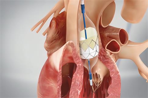 1700609890163500.jpg 攝圖網_330241749_冠心血管成形術和刺塞插入導尿藥品程序心臟病學支架閥門醫療插圖手術形術(企業商用).jpg