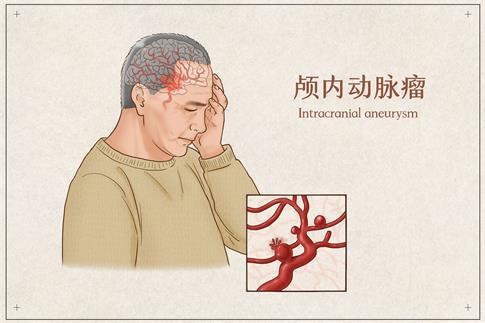 1701071482469643.jpg 攝圖網_401796266_顱內動脈瘤醫療插畫(企業商用).jpg