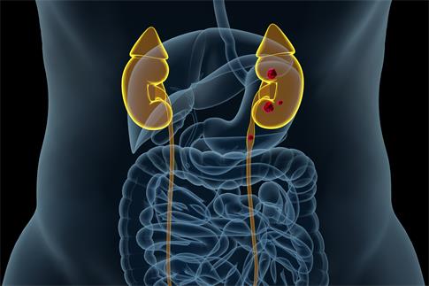 1701820962141114.jpg 攝圖網_401860884_腎結石病變場景(企業商用).jpg