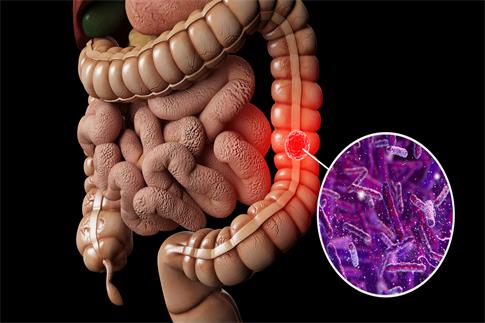1732329958536655.jpg 攝圖網_401865910_人體腸癌場景(企業商用).jpg
