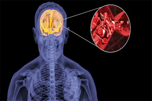 1736741151521794.jpg 攝圖網_401865921_人體腦淤血(企業商用).jpg